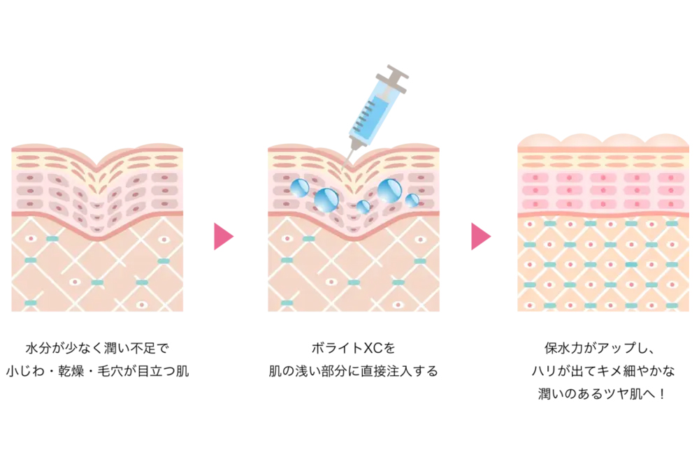 水分が少なく乾燥して小じわが目立つ肌に、スキンバイブ（ボライトXC）を皮膚の浅い層へ少量ずつ注入し、保水力が上がってハリのある肌へ整う流れを3段階で示した図です。