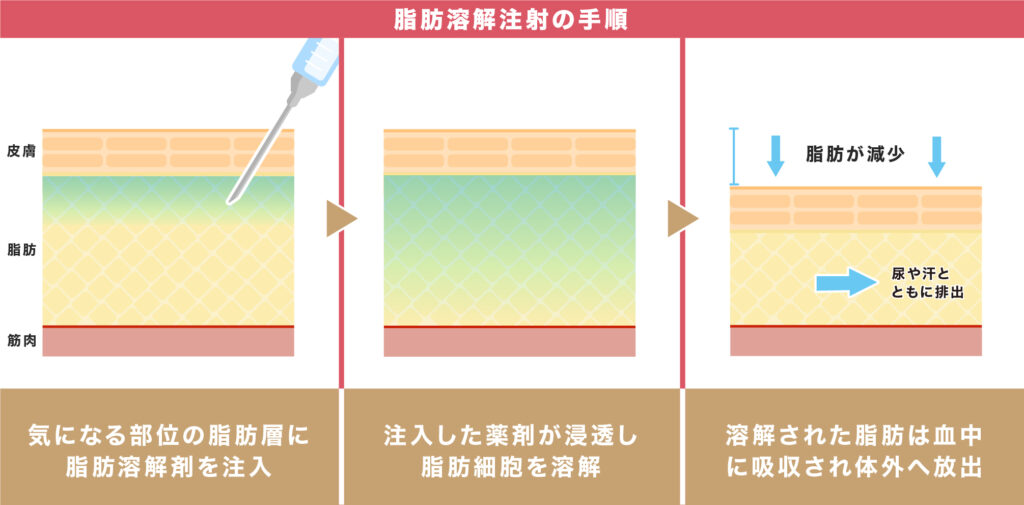 脂肪溶解注射の手順