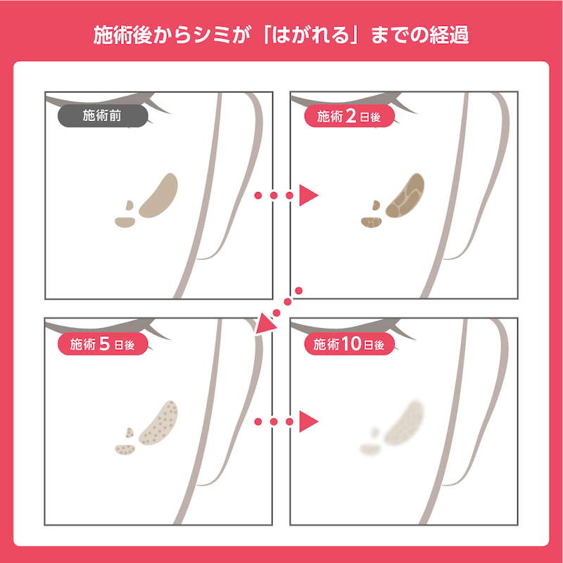 フォトフェイシャルの施術後からシミがはがれるまでの経過を表したイラスト。4コマに分かれており、左上が施術前、右上が施術2日後でシミがかさぶたのように一時的に濃くなっている、左下が施術5日後でかさぶたが剥がれた後の様子、右下が施術10日後で残っていた色素が排出されかなり薄くなった様子が順に示されている。