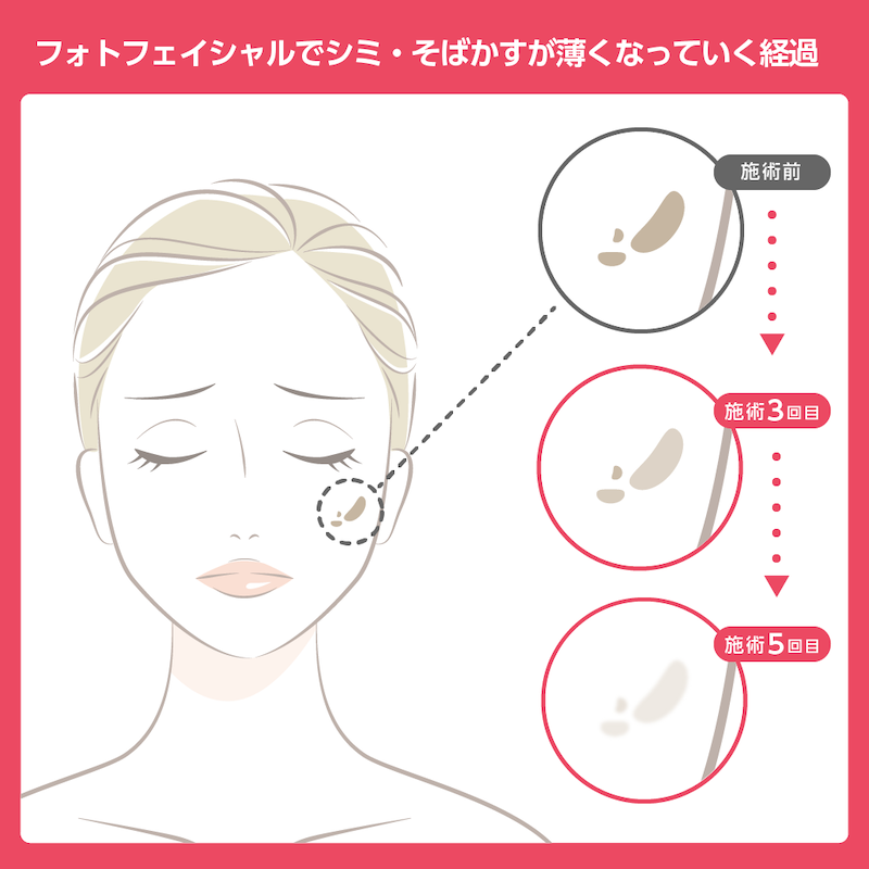 フォトフェイシャルでシミ・そばかすが薄くなっていく経過を表したイラスト。女性の頬にある施術前の濃いしみが施術3回目で少し薄くなり、施術5回目ではかなり薄くなっていく様子を示している。