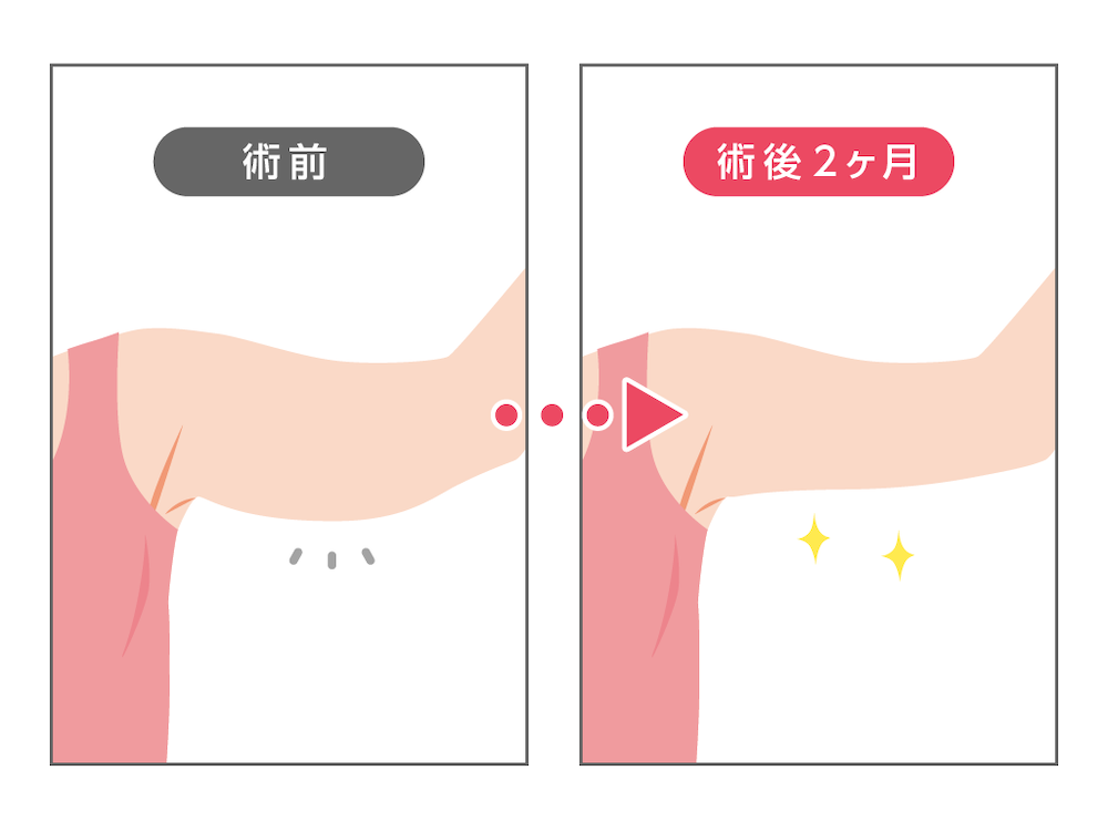 女性の二の腕のイラストで、施術前と施術後2か月を並べて比較した図。左の施術前は二の腕の下側にたるみが描かれ、右の施術後は余分なふくらみが減って腕のラインがすっきりし、きらっとした光のマークが添えられている。