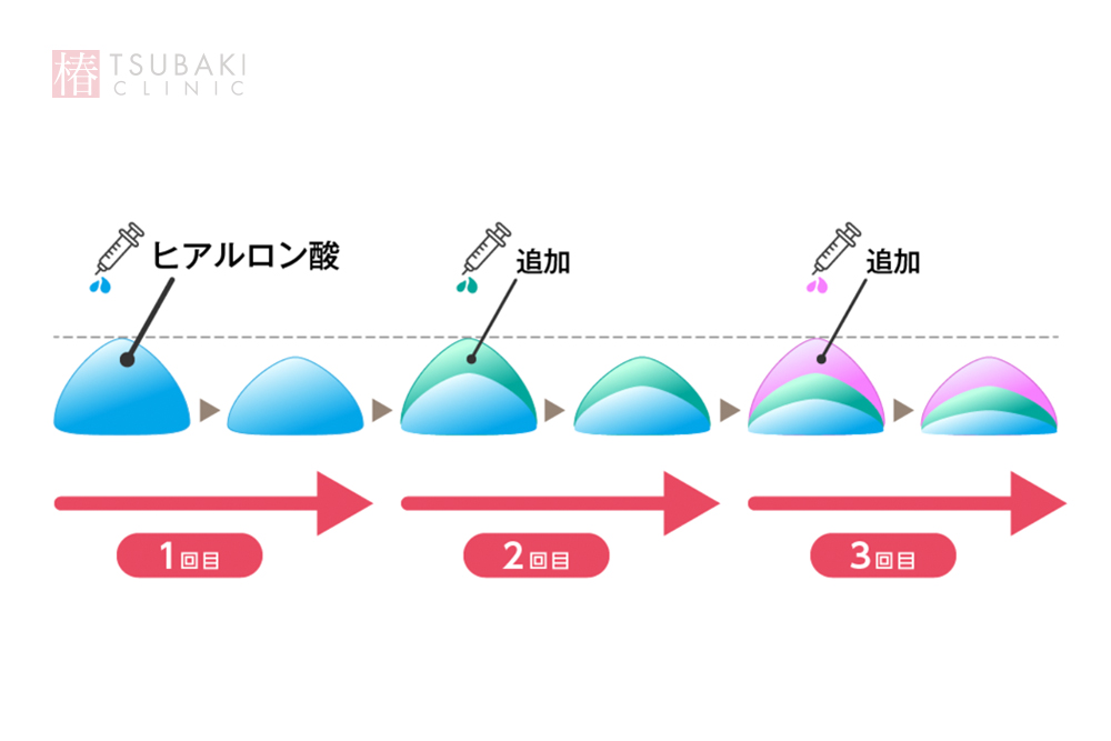 注入したヒアルロン酸が回数を重ねる毎に積み重なっていく様子をあらわしたイラスト。