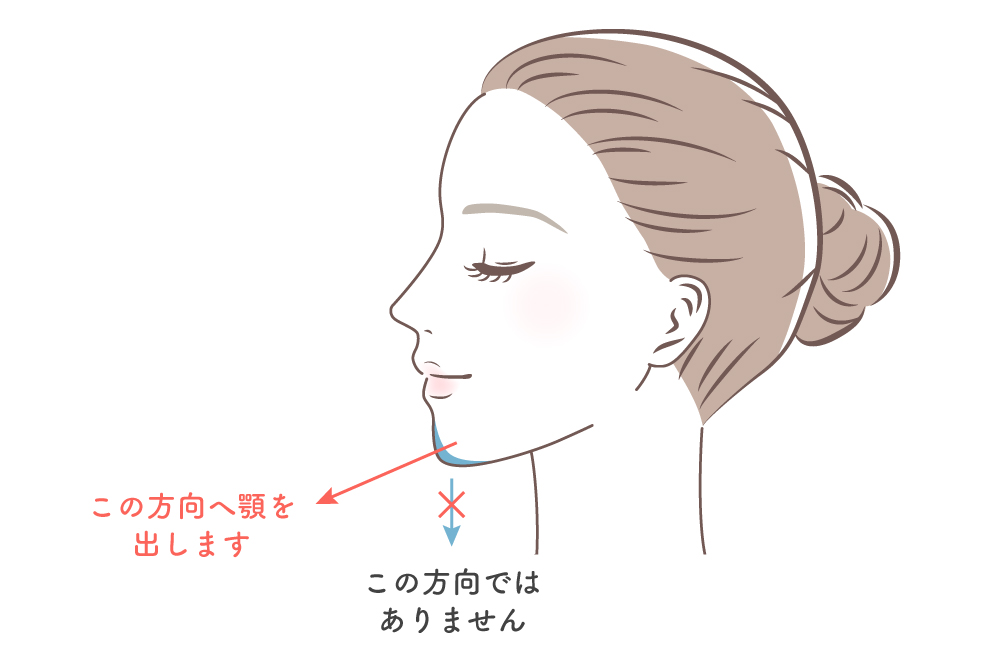 顎のヒアルロン酸注入で、ヒアルロン酸を入れる部位を下方向ではなく、斜め前方向に出るように注入することを示したイラスト。