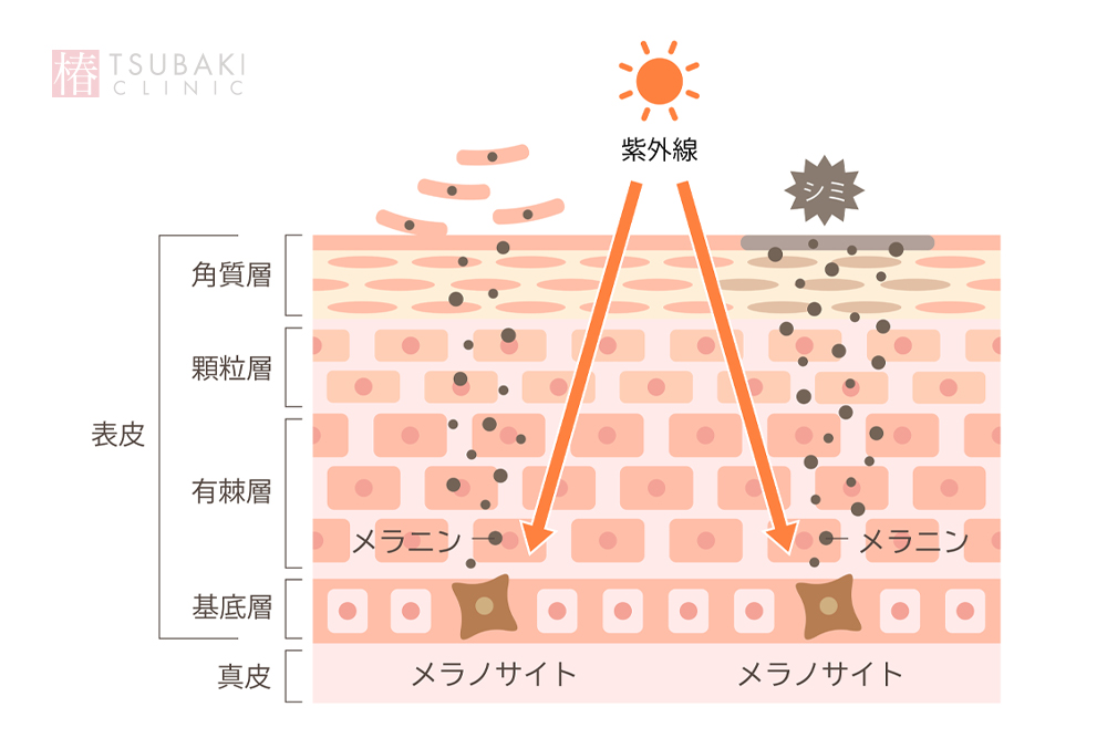 レーザートーニング中断後の肌変化