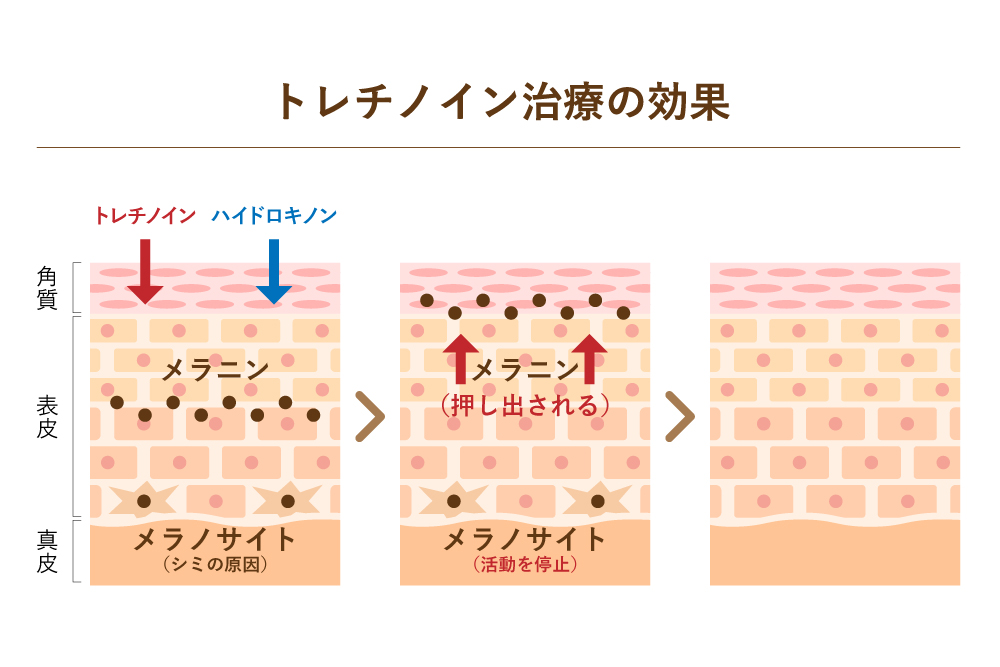 トレチノイン治療の効果