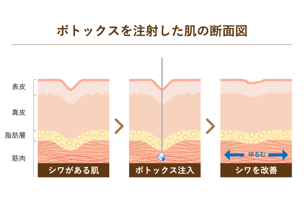 ボトックス注射がシワのある肌に作用し、筋肉の動きを抑えてシワが改善する仕組みを示した皮膚断面図