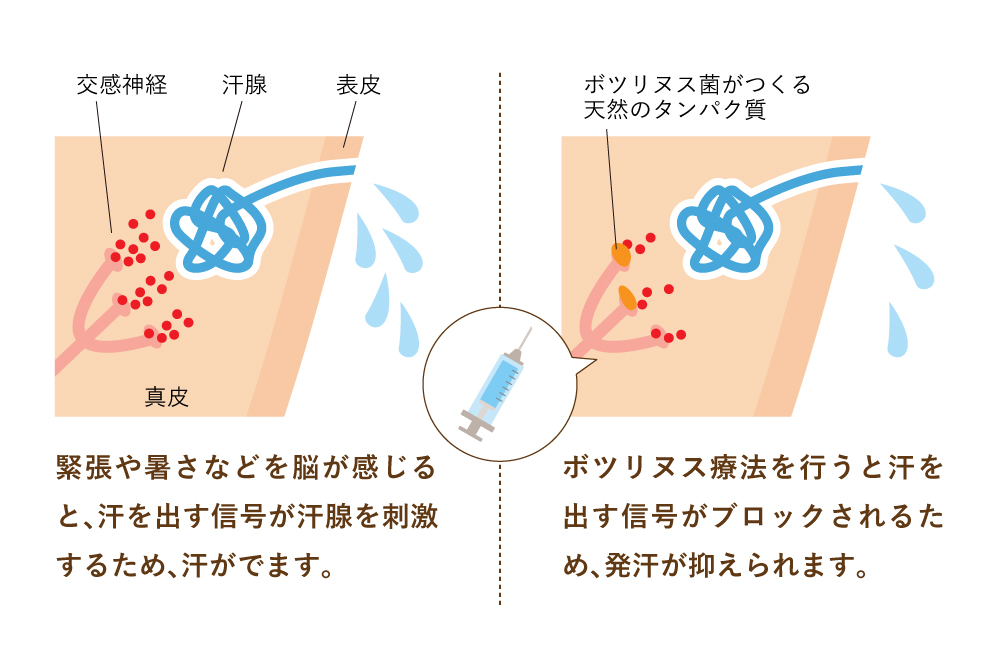 脇汗に対してのボトックスの働きを解説したイラスト。ボツリヌス治療を行うと汗を出す信号がブロックされるため、汗腺からの分泌が低下する。