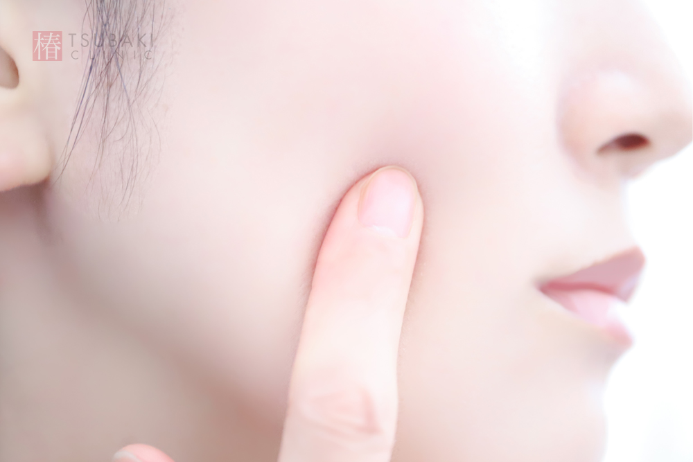 ハイフ治療の成功体験