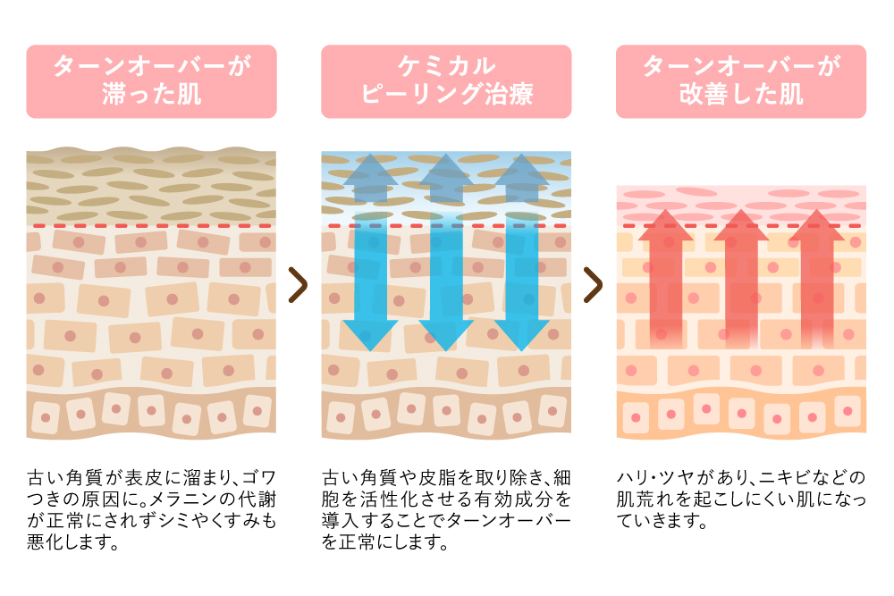 ピーリングってどんな施術？基本を知ろう