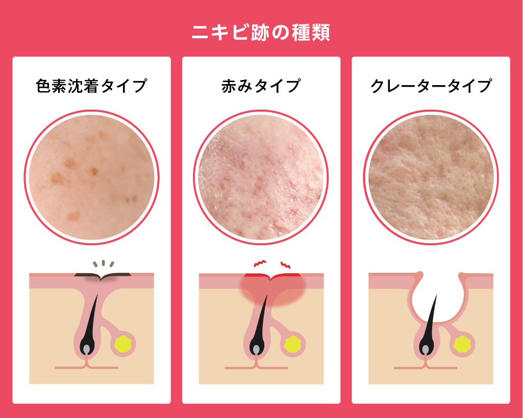 ニキビ跡の種類