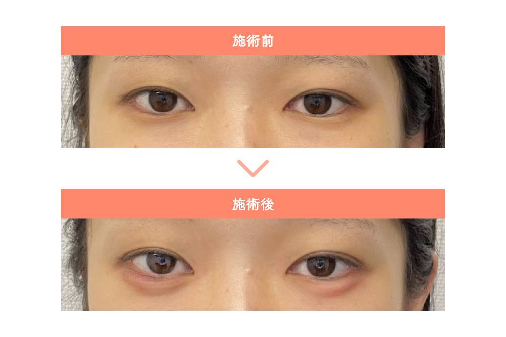 涙袋のヒアルロン酸注入施術を椿クリニックで受けた女性の施術前と施術後の写真。