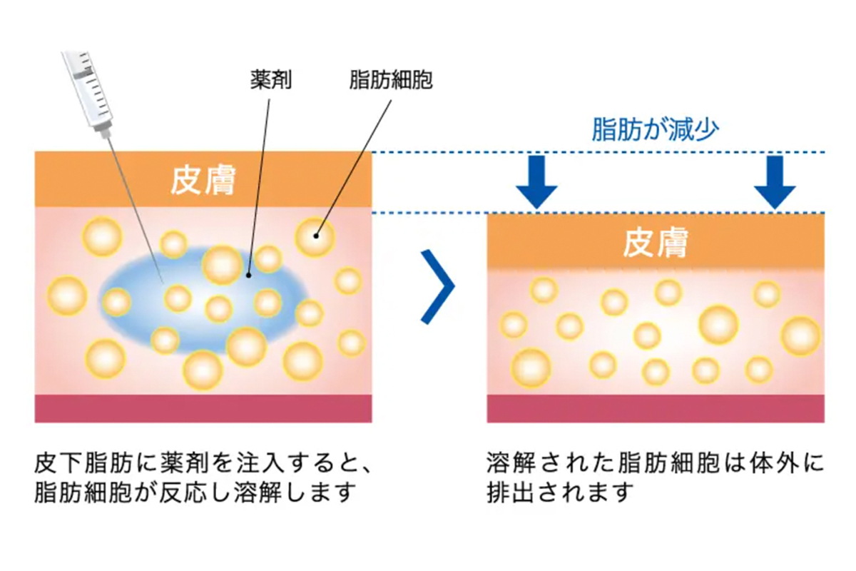 皮膚の下に薬剤を注射すると、脂肪細胞が反応して溶け出す様子を示した図。左側では注射針から薬剤が脂肪層に入り、黄色い脂肪細胞が青く広がる薬剤に包まれて溶解していく過程を描いている。右側では、溶けた脂肪細胞が体外へ排出され、脂肪層が薄くなり“脂肪が減少”と示されている。