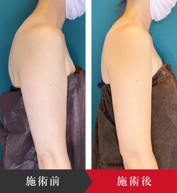 椿クリニックの二の腕施術の症例写真。腕を下ろした横向き姿勢で施術前と施術後を比較しており、施術後は二の腕のふくらみがやや軽くなり、腕のラインがすっきり見える。