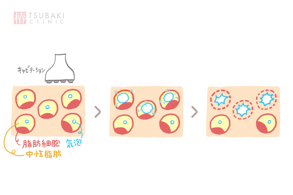 キャビテーション施術で脂肪細胞に変化が生じる流れを示した3段階のイラスト。
左の図では、皮膚の下に並ぶ脂肪細胞のまわりに青い気泡が生じている。
中央の図では、気泡が大きくなり脂肪細胞の膜が揺らぎ始めている様子が描かれている。
右の図では、脂肪細胞の膜が壊れ、中性脂肪が外に出ていく状態が示され、細胞が縮小していることがわかる。
