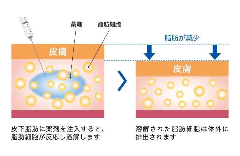 皮下脂肪に直接注射