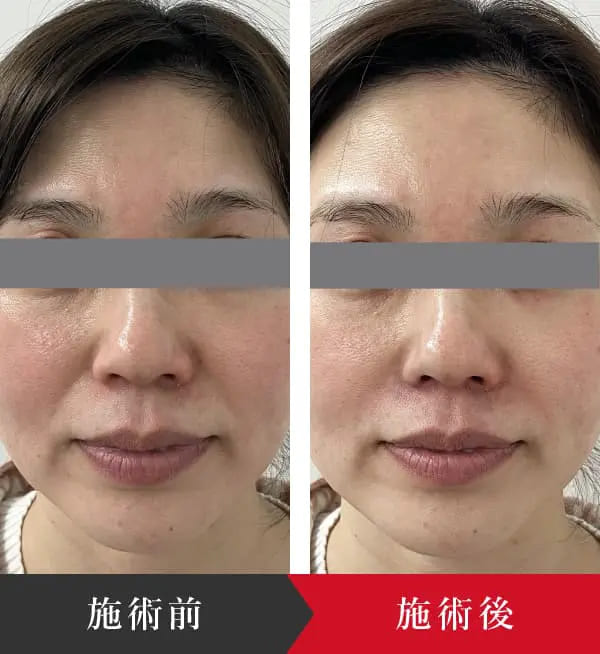 椿クリニックでほうれい線にヒアルロン酸注入を行った40代女性のビフォーアフターの症例写真。