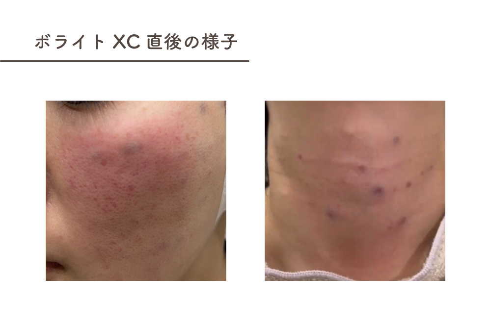 スキンバイブ（ボライトXC）はどこに入れるの？スキンバイブ（ボライトXC）の効果とともに解説します