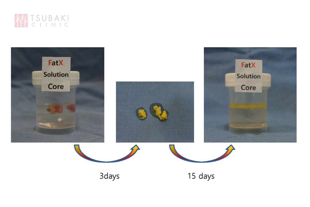 FatX coreの施術後の経過:日々の変化