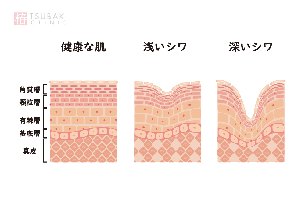 健康な肌とシワのある肌