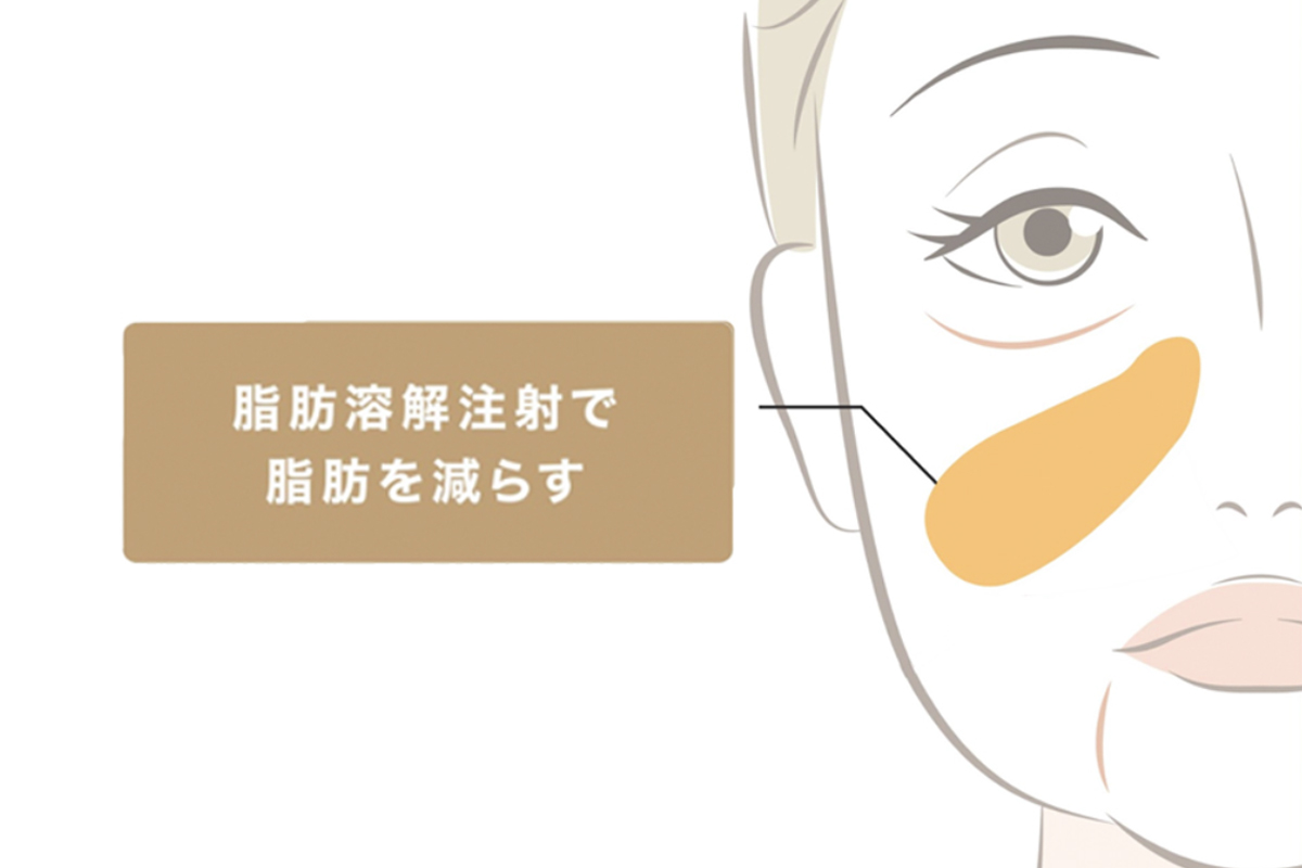 脂肪溶解注射で脂肪を減らす部位を表したイラスト。ほうれい線の少し上の部分を減らすことが示されている。