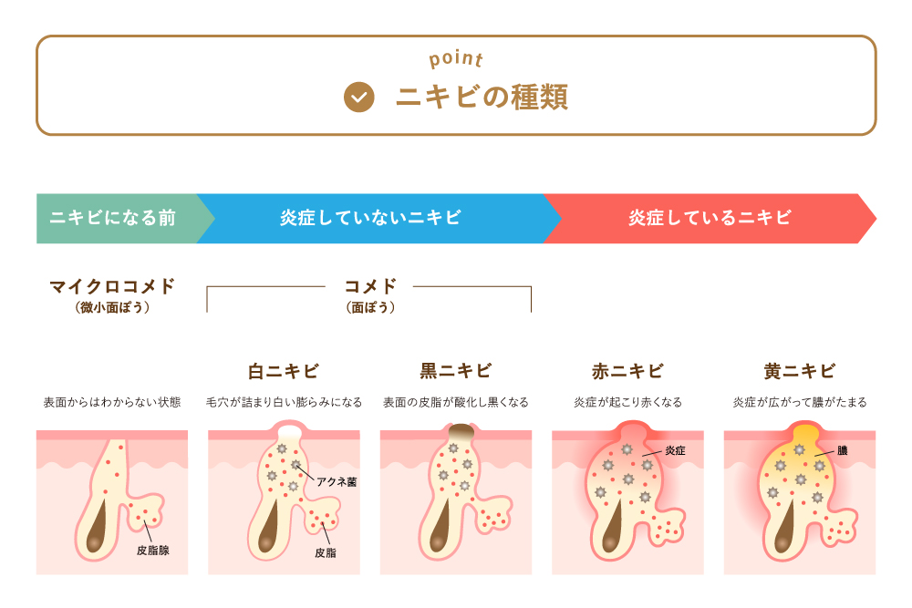 ニキビの種類