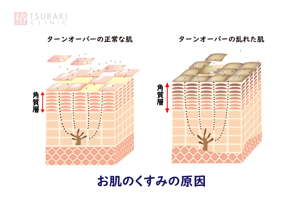 お肌のくすみの原因