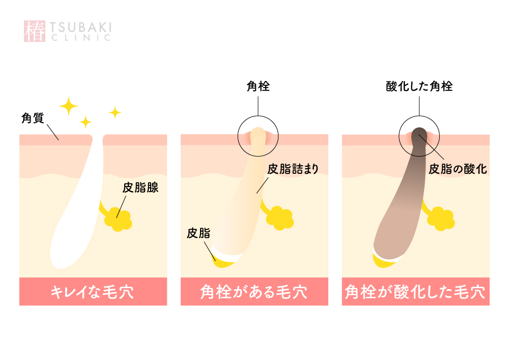 キレイな毛穴・角栓がある毛穴・角栓が酸化した毛穴のイラスト