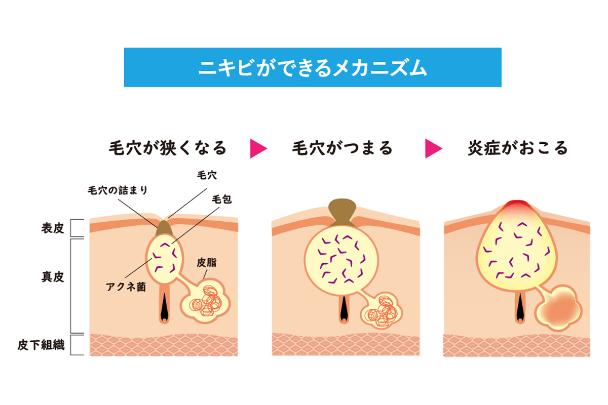 ニキビができるメカニズムを肌の断面図で表したイラスト。左から毛穴が詰まり狭くなる様子、毛穴が詰まることで真皮層の毛包にアクネ菌が繁殖する様子、毛穴に炎症が起きる様子を示している。