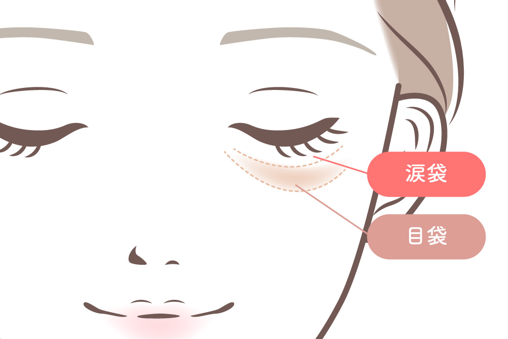 涙袋と目袋の違いを示したイラスト。