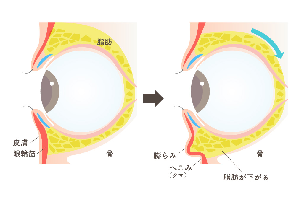 目の周りを横から見た断面イラスト。左は通常の状態で、皮膚・眼輪筋・脂肪・骨の位置が示されている。右は目の下の脂肪が下がり、目袋の「膨らみ」と、その下に「へこみ（クマ）」ができる仕組みを矢印で説明しています。