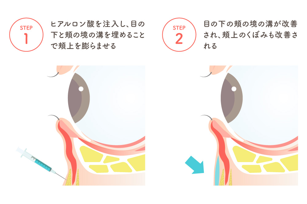 目の下の凹みをヒアルロン酸注入で整える流れを説明する図です。STEP1では注射器で目の下の境目付近にヒアルロン酸を入れ、凹みや溝をなだらかにして頬を持ち上げます。STEP2では溝が改善され、目の下のふくらみも目立ちにくくなる様子が描かれています。