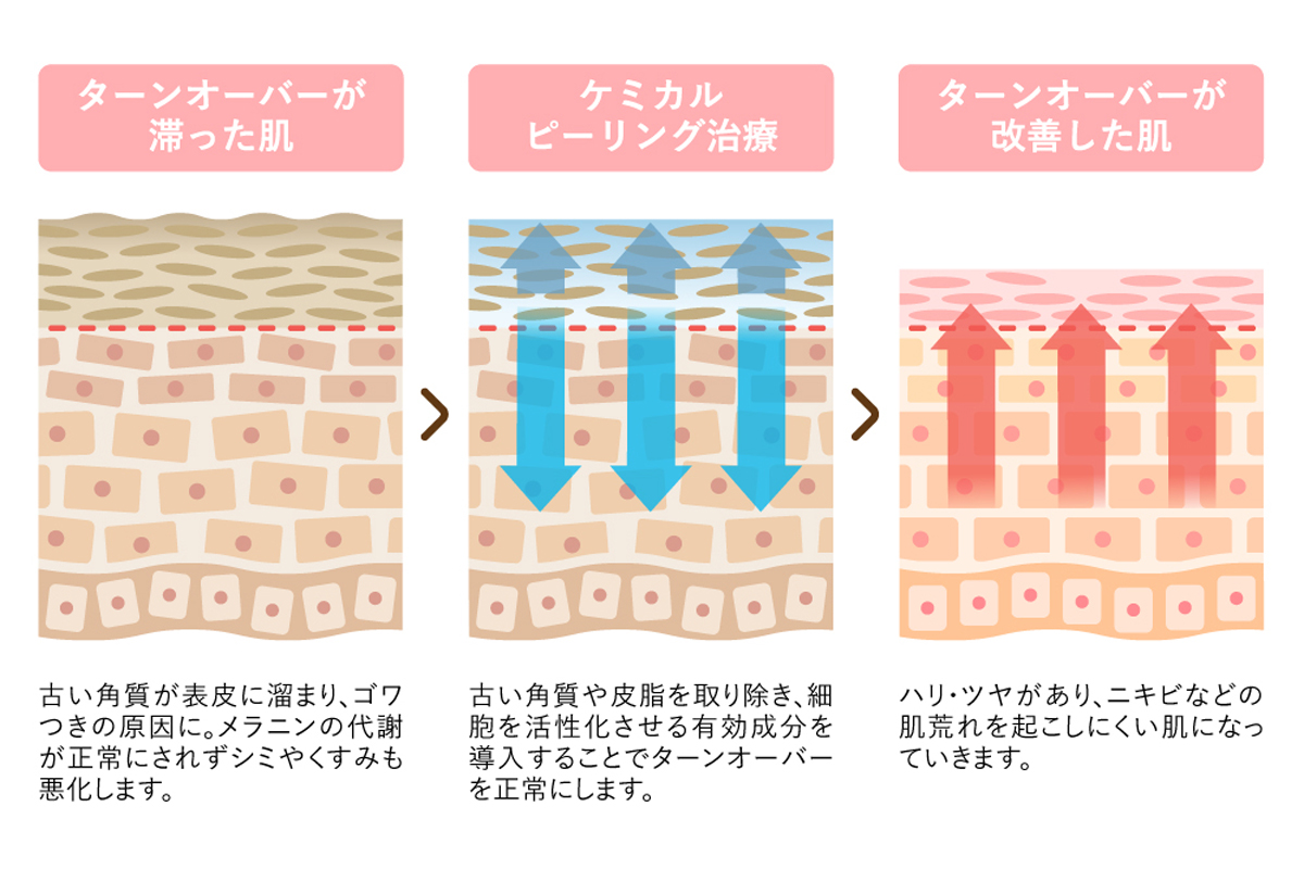 ケミカルピーリングによってターンオーバーが整う様子を肌の断面図で示したイラスト。左から順にターンオーバーが滞って角質が厚くくすんだ肌、ケミカルピーリングによって古い角質を取り除く様子、ターンオーバーが改善して角質の肥厚やくすみが改善され肌細胞の並びが整った様子がそれぞれ描かれている。