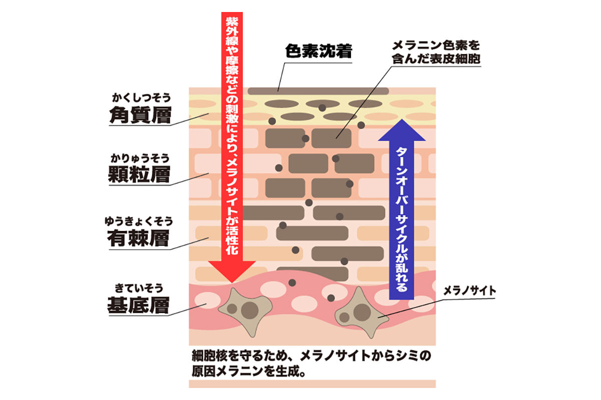色素沈着ができる流れを肌の断面図で説明したイラスト。紫外線などによって基底層のメラノサイトが刺激されメラニンが生成、ターンオーバーのサイクルが乱れることで有棘層・顆粒層・角質層とメラニンが積み重なる。