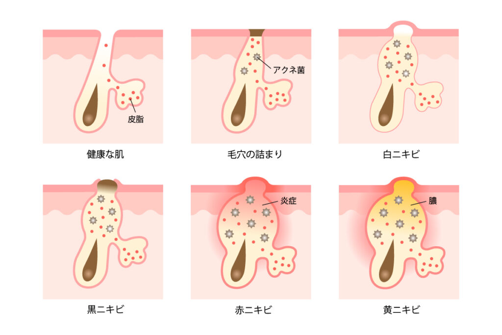 健康な肌の毛穴と、毛穴詰まりを起こした毛穴、ニキビができた毛穴をそれぞれ比較して表したイラスト。
