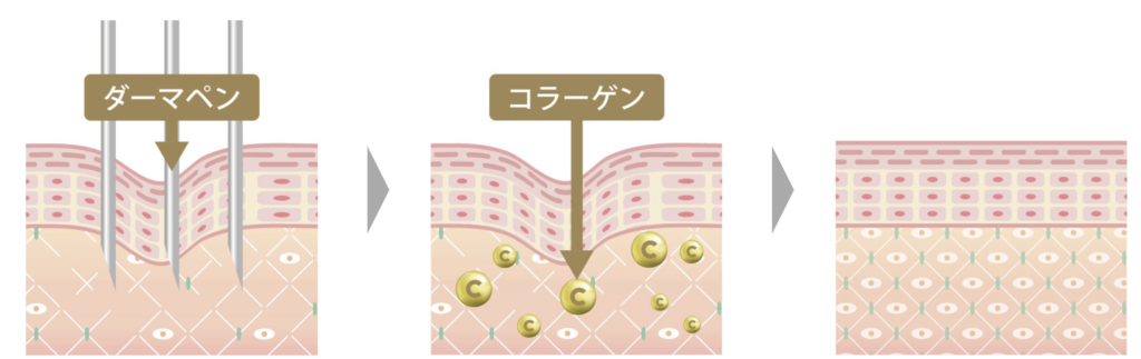 ダーマペンによる肌のはりの回復を表した肌断面図のイラスト。ダーマペンによってコラーゲン生成が促され肌のハリが回復している。