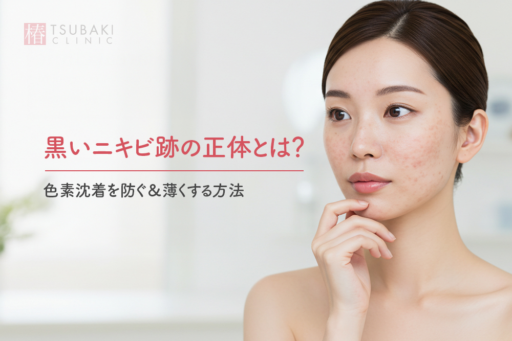 黒いニキビ跡の正体とは？色素沈着を防ぐ＆薄くする方法