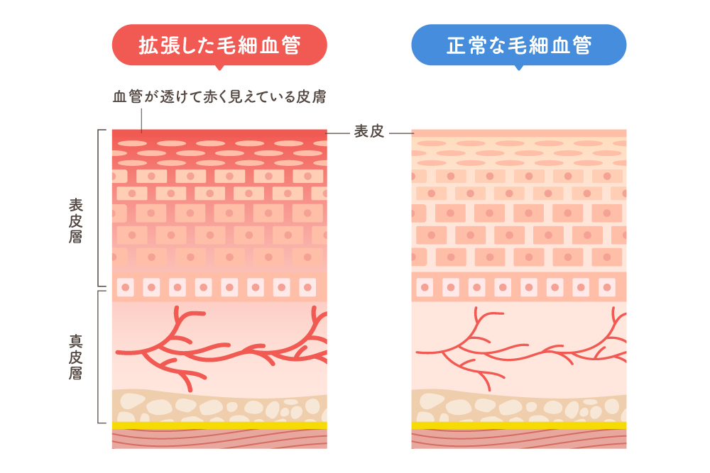 掻きむしった後に赤くなったり、茶色っぽく色素沈着になったりして、残った跡が気になる人も多いのではないでしょうか。掻きむしり跡を目立たなくさせるためには、日々のスキンケアが重要です。まずは掻きむしり跡ができる原因について見ていきましょう。

掻きむしり跡が残る原因とは？肌への影響を解説

掻きむしり跡が残る原因は、皮膚に強い摩擦が起き、長時間炎症が起きていたことが原因です。
掻きむしり跡には、赤みの残るものと、色素沈着として残るものの2種類があります。赤みの残る掻きむしり跡は、部分的に長時間炎症を起こし、その炎症を鎮めようと毛細血管が拡張することで起こります。特に顔の皮膚は薄く血管が透けて見えやすいため、拡張した毛細血管が集まると皮膚表面から見たときに、赤みが残って見えてしまいます。