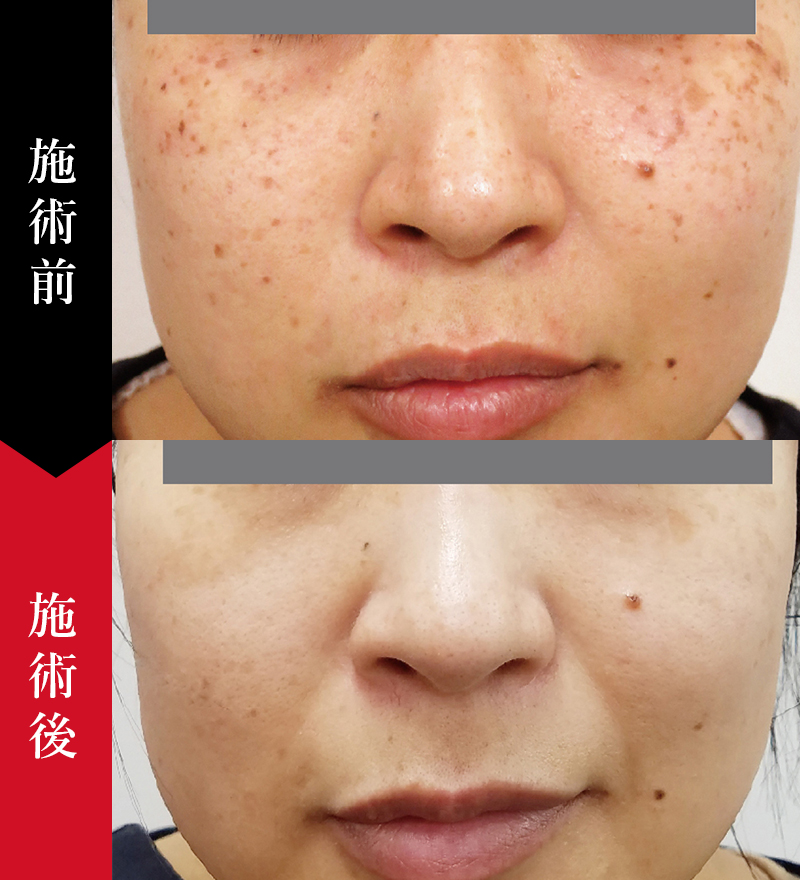 フォトフェイシャル治療で頬のそばかすが改善した女性のビフォーアフターの症例写真。