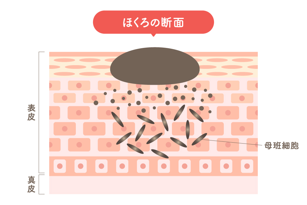 皮膚の深い層まで細胞が入り込んでおり、盛り上がっていたり、色が濃く黒っぽいことが多い