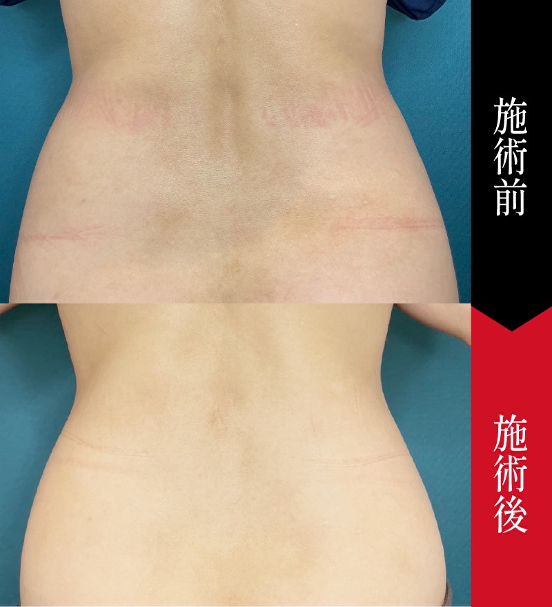 脂肪溶解注射（体）