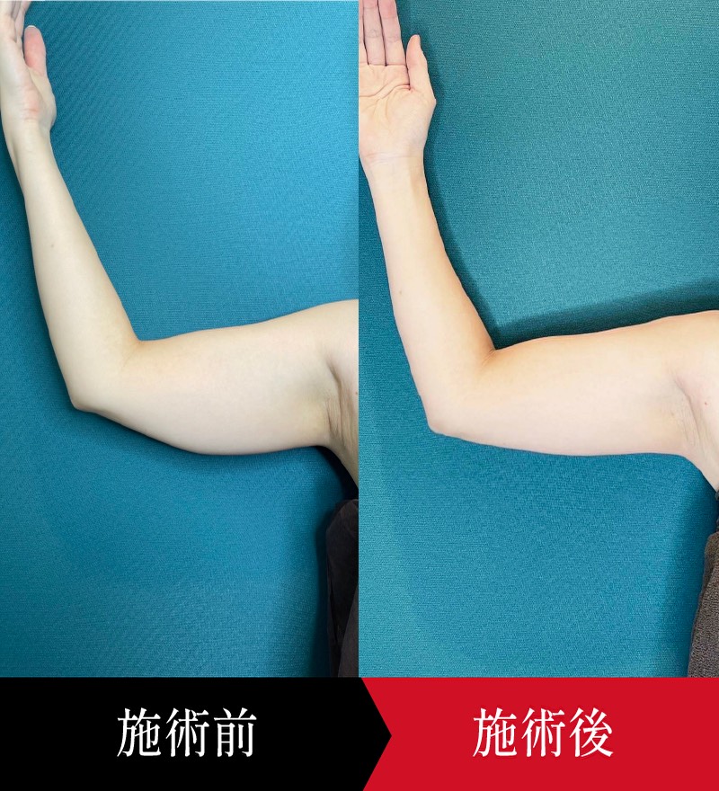 椿クリニックの二の腕施術の症例写真。肘を曲げて腕を上げた姿勢で施術前後を並べており、施術後は二の腕の下側の厚みが減り、全体が引き締まって見える。