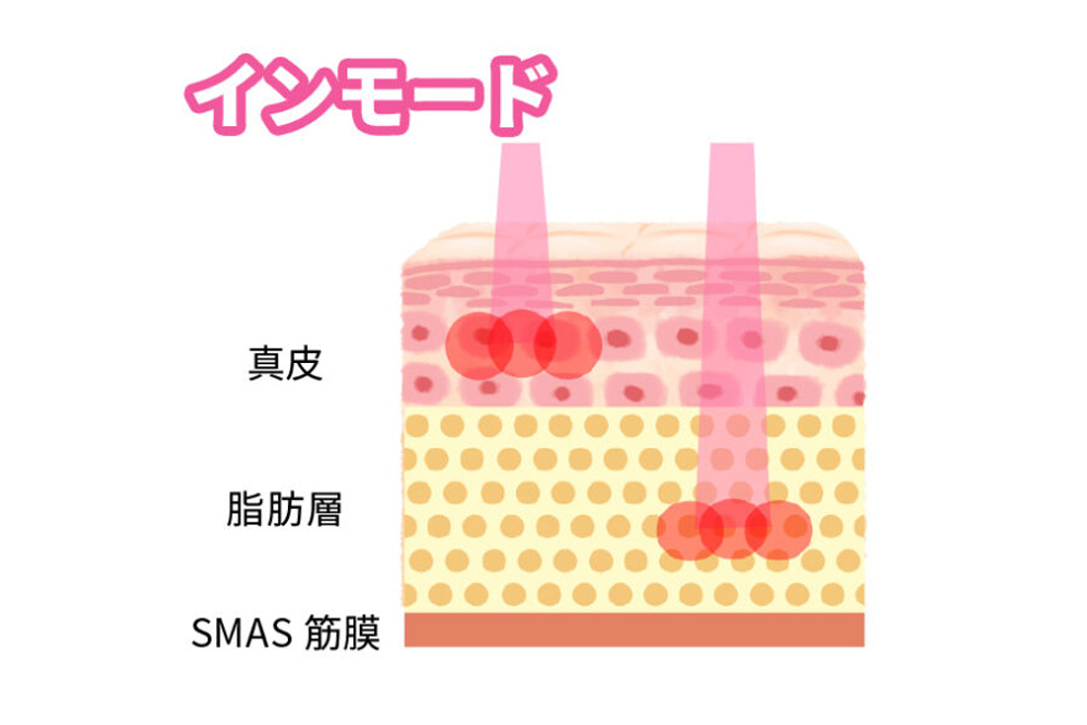 インモードの熱刺激の深度を肌の断面図とともに表したイラスト。真皮と脂肪層にそれぞれ熱刺激が加わっていることがわかる。