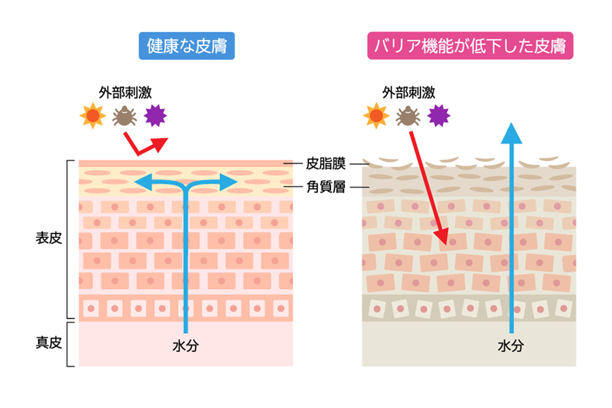健康な皮膚とバリア機能が低下した皮膚を肌の断面図で示したイラスト。左は皮脂膜や角質層が整っており水分が表皮内で保持され、紫外線などの外部刺激をブロックしている。一方で右の皮膚は皮脂膜や角質層が乱れ真皮層からの水分が外に逃げ、紫外線などの外部刺激が表皮にダメージを与えている。