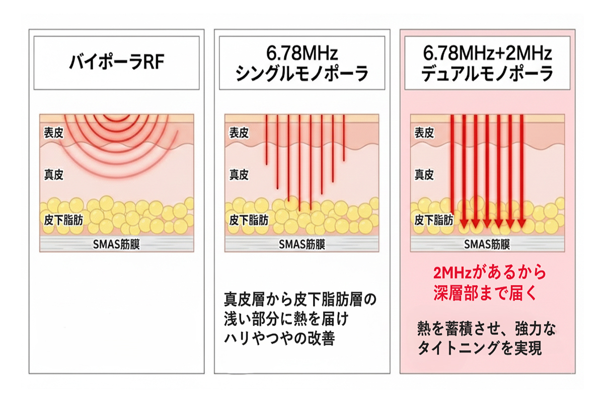 ザーフのエネルギーの伝わり方を表したイラスト。左は肌の表面に近いところが温まり、中央はもう少し深い部分まで温まります。右は「2メガヘルツ」を足すことでさらに深い層まで熱が届き、肌を引き締める仕組みを示しています。